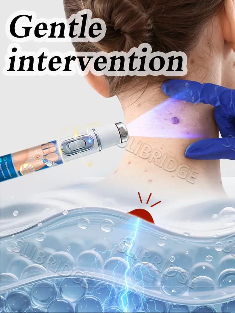 Today's Deal,free shipping,blue light pen solve warts,wart care tools,Bestselling - image 4